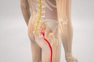 How Long Does Sciatica Last? Recovery Timeline, Stages & When to See a Doctor