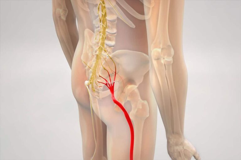 How Long Does Sciatica Last? Recovery Timeline, Stages & When to See a Doctor