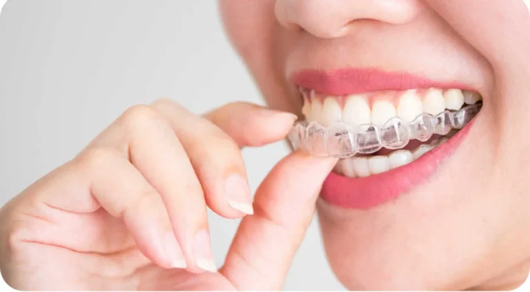 Top Invisalign Providers in San Diego: What to Look for Before You Choose