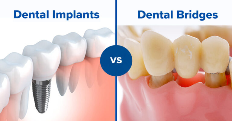 Partial Dentures vs Implants vs Bridges: Cost Comparison Guide